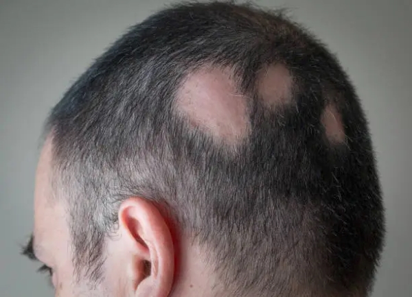 alopecia a chiazze aerata